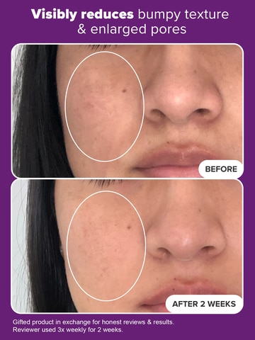 Niacinamide 20% Treatment