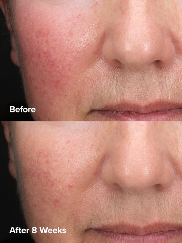 6% Mandelic Acid + 2% Lactic Acid Liquid Exfoliant