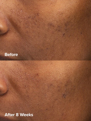 6% Mandelic Acid + 2% Lactic Acid Liquid Exfoliant