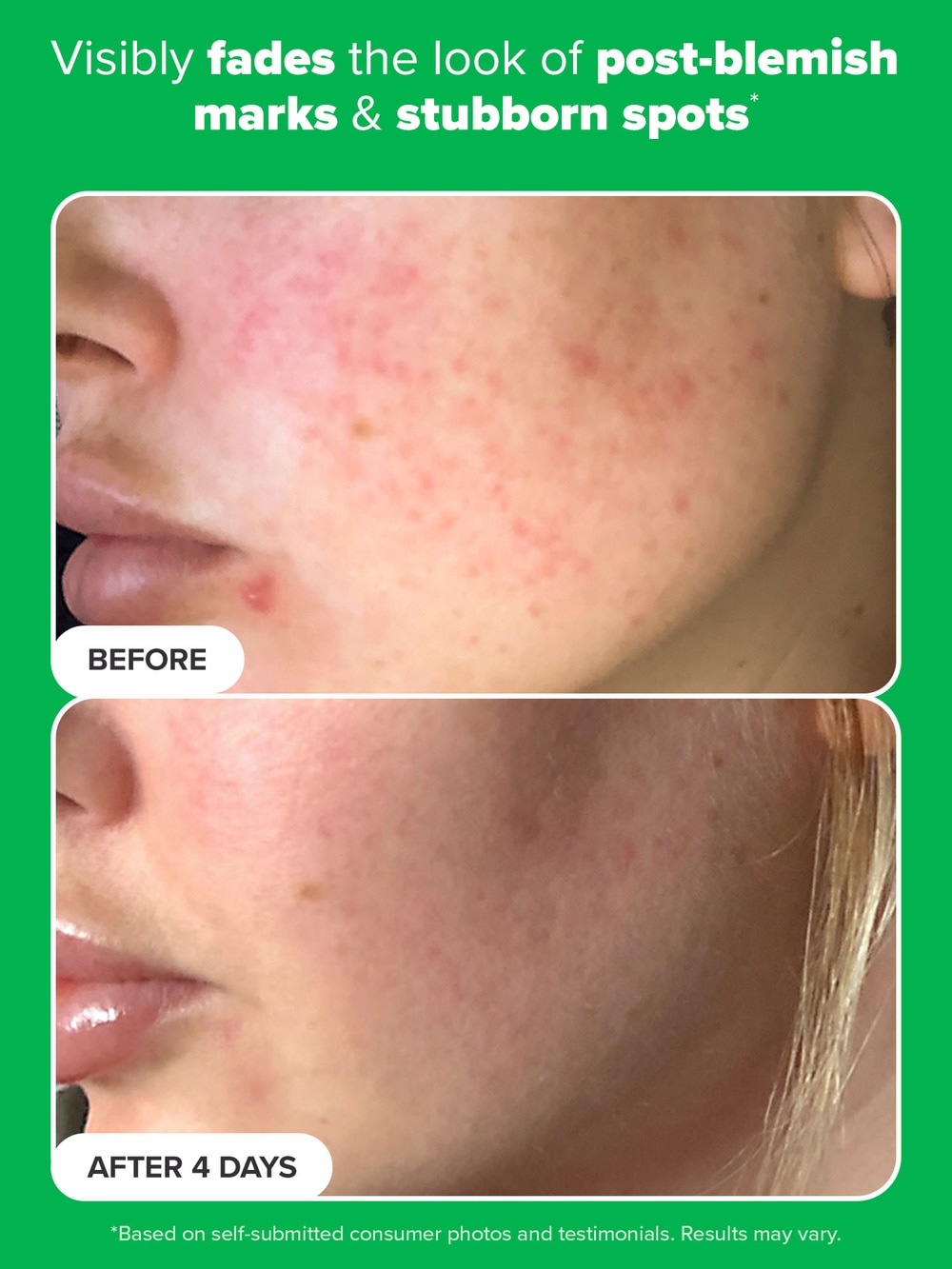 10% Azelaic Acid Booster