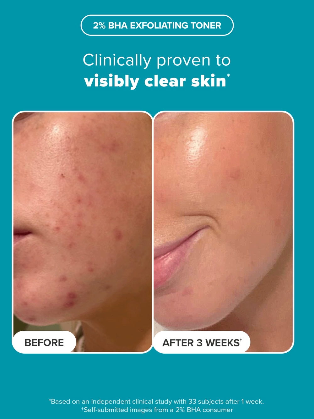 BHA Kit for Face & Body