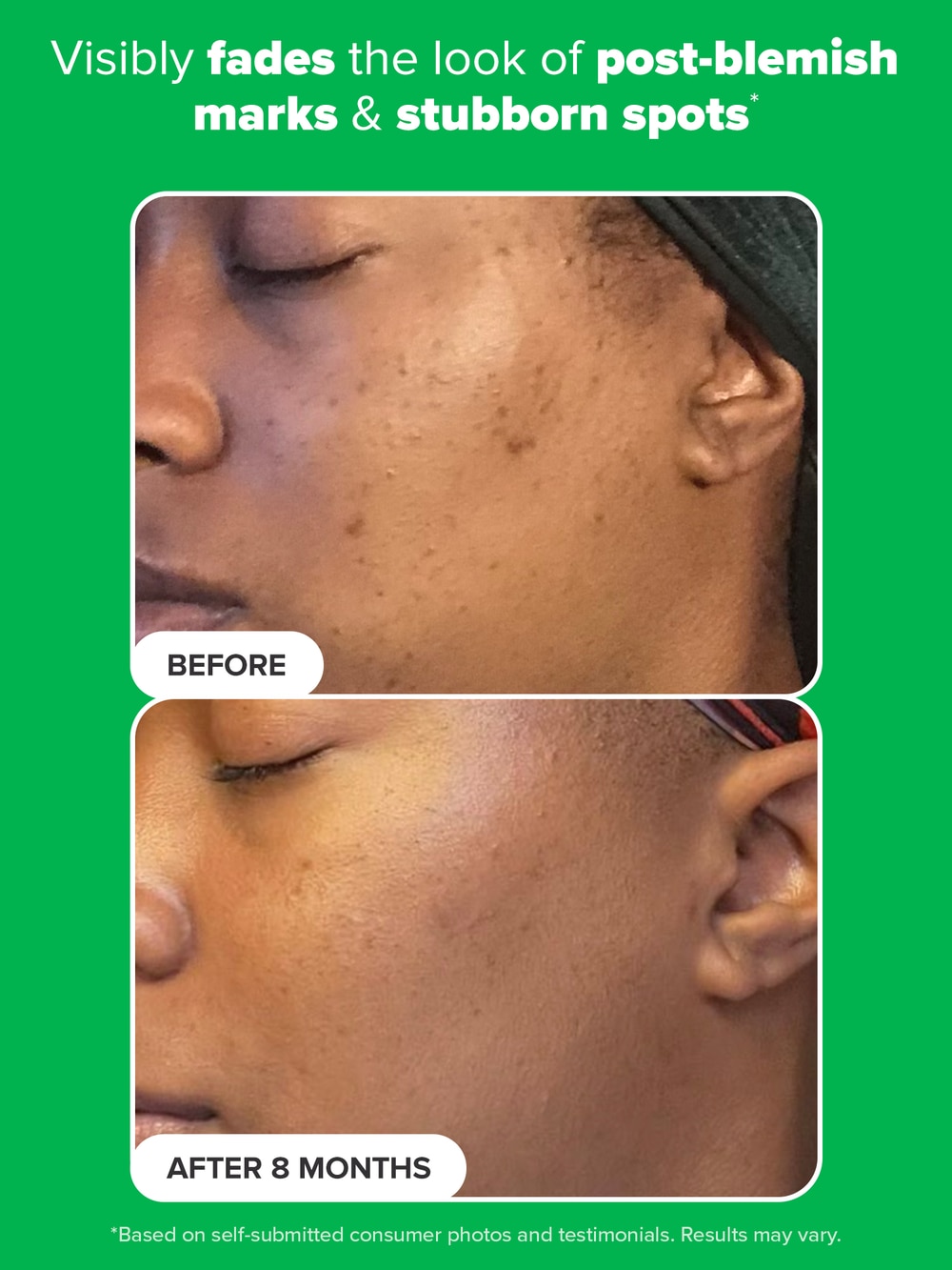 10% Azelaic Acid Booster