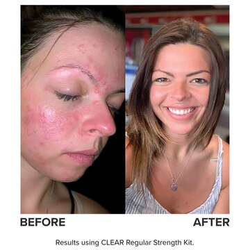 Clear Anti Redness Exfoliating Solution 2 Salicylic Acid Paula S Choice Is it right for you?