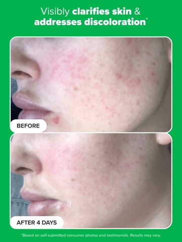 10% Azelaic Acid Booster