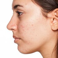 Types of Acne Breakouts