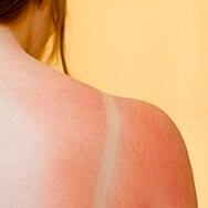 What Is a Sunburn?
