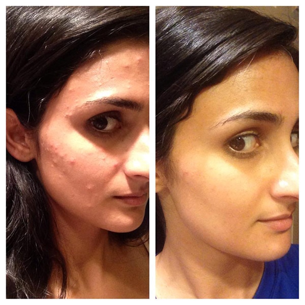 Before and after using the Paula's Choice CLEAR line. Simple Steps, Big Results, Clearer Skin.