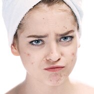 How to Treat Teen Acne