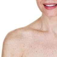How to Deal with Sun Spots on the Body