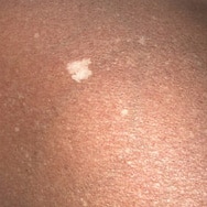 What Are These White Spots on My Skin?