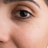 What Are These Tiny White Bumps on My Face?