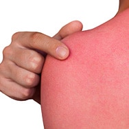 Sun Damage Explained