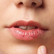 Solutions for Dry, Cracked Lips