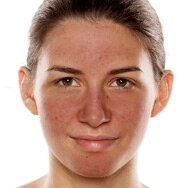 Skincare Tips for Calming Redness